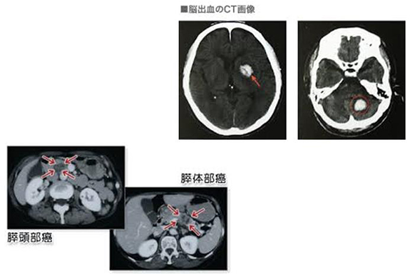 脳出血のCT画像