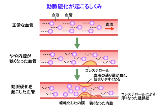 血圧をホースに例えれば