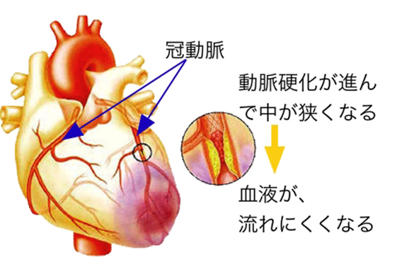 高血圧がまねく病気②・・・心筋梗塞、それは突然発症します。