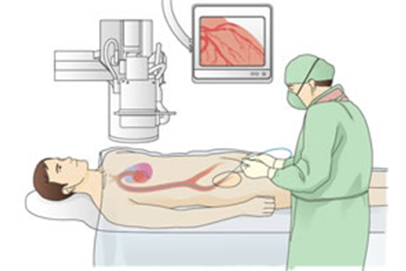 狭心症、心筋梗塞の治療　②カテーテル治療