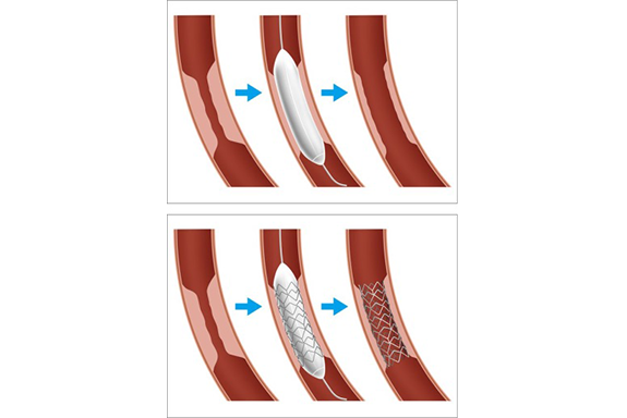 狭心症、心筋梗塞の治療　②カテーテル治療