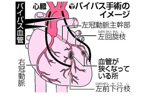 狭心症、心筋梗塞の治療　③バイパス手術